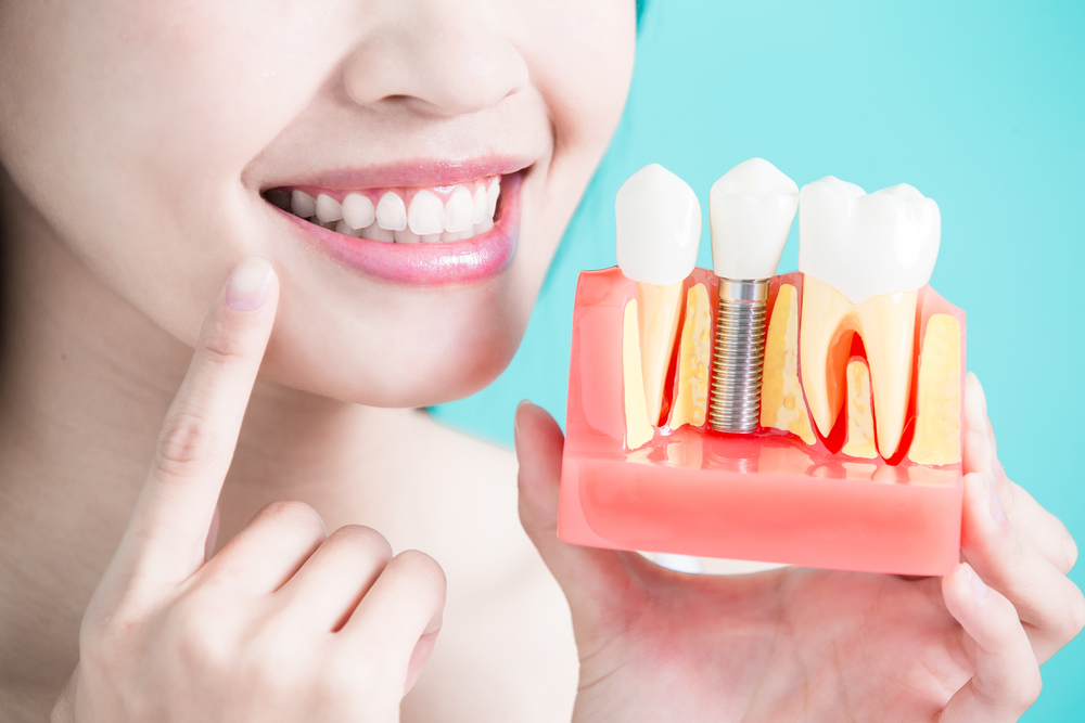 Expert Dental Implants with Comfort and Lasting Results