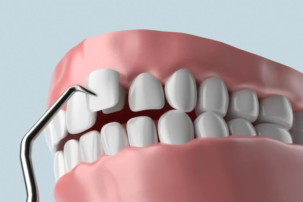 Implants & Veneers 1 Implants & Veneers Services