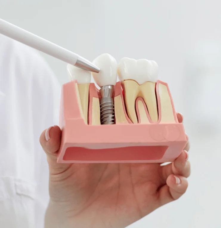Implants & Veneers 2 Implants & Veneers Services in USA