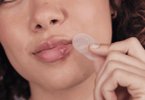 cold sore patches