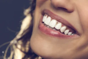 composite bonding teeth