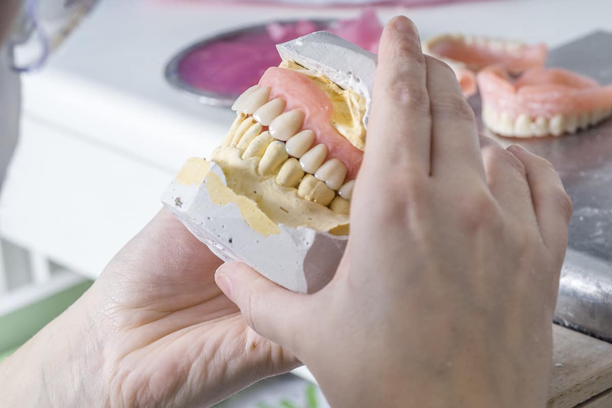 full mouth dental implants