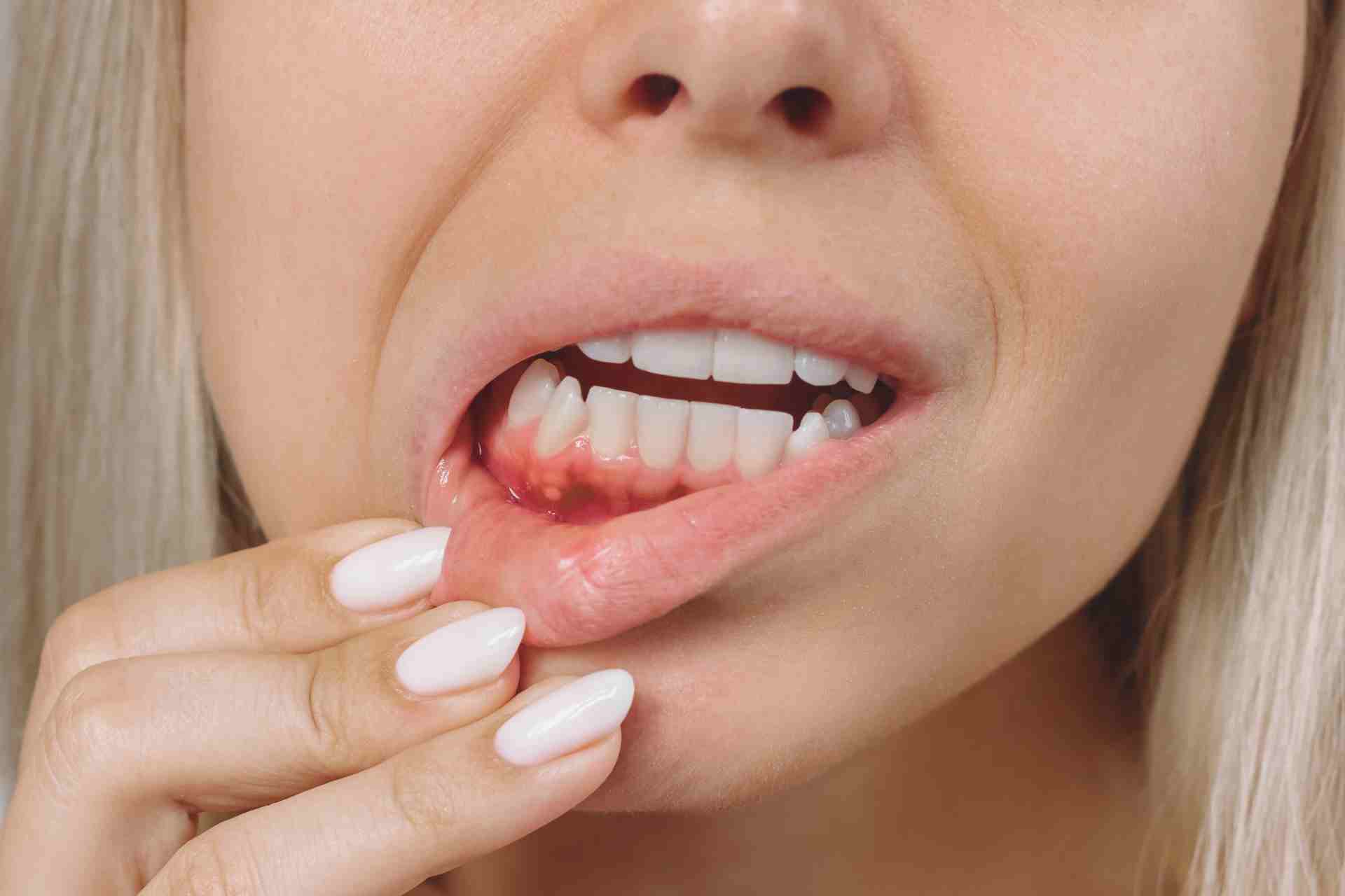 gum pimple
