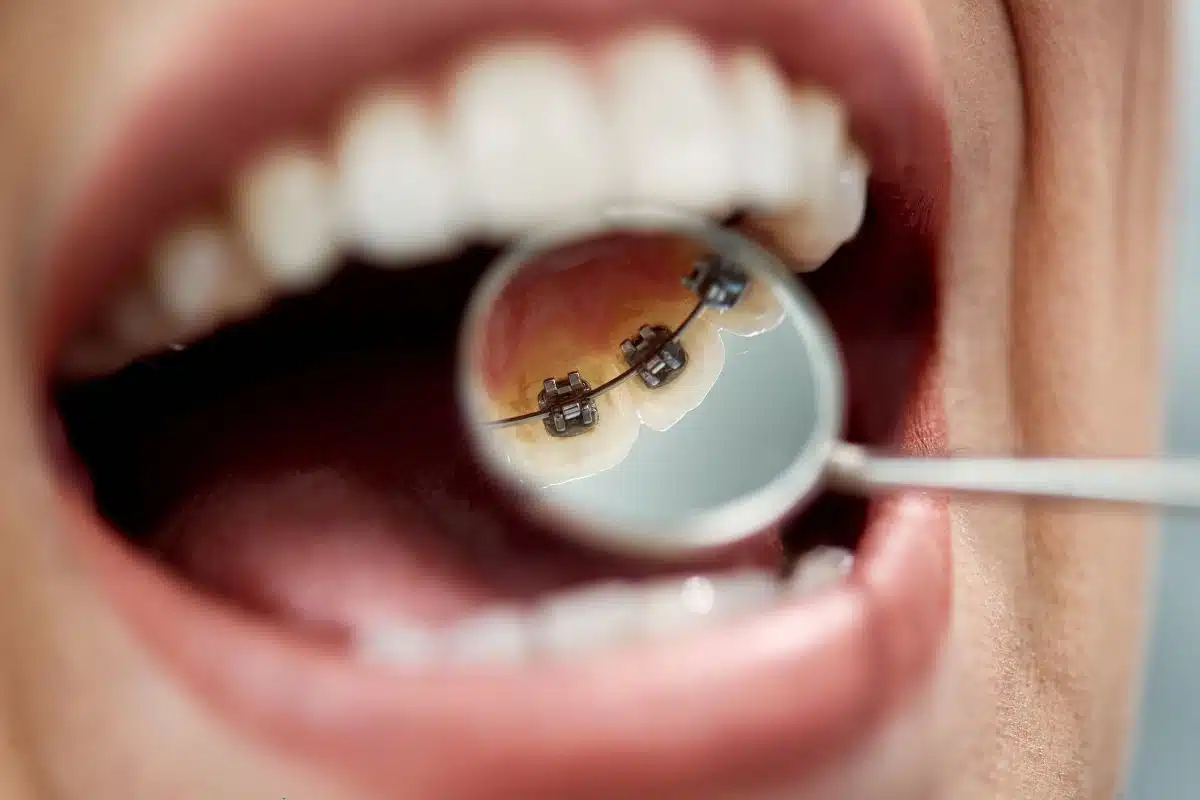 retainers for teeth