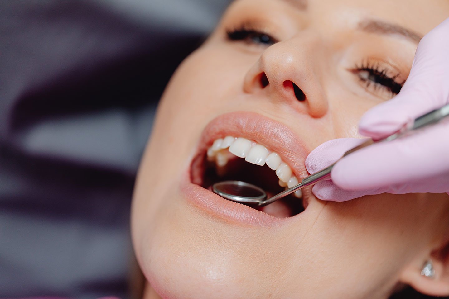 tooth filling