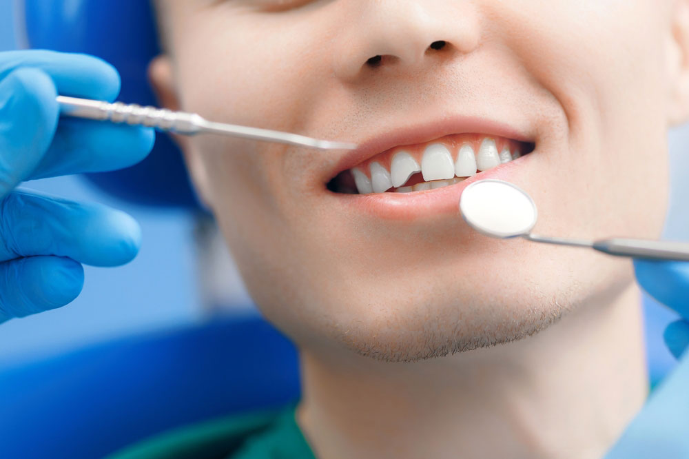 Fractured Tooth Repair