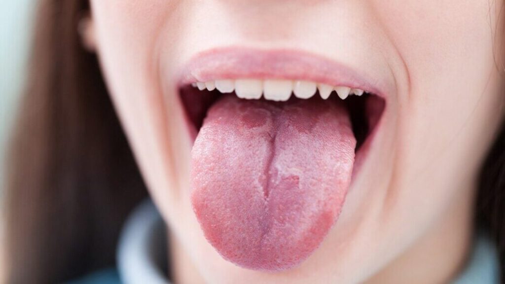 how to heal burnt tongue