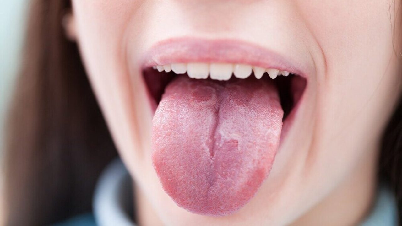 how to heal burnt tongue