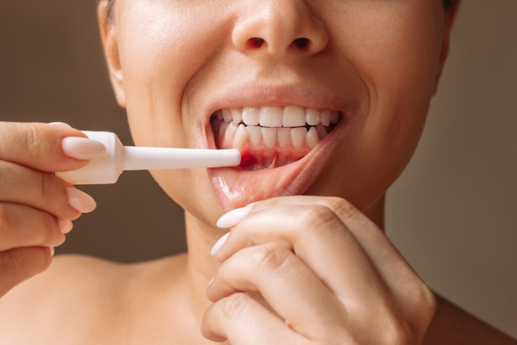 How to Cure Mouth Ulcers Fast Naturally