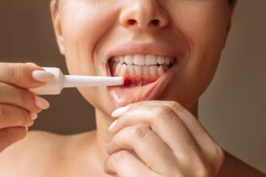 How to Cure Mouth Ulcers Fast Naturally