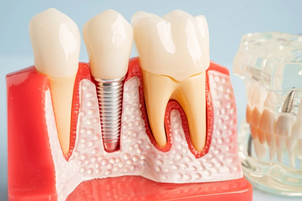Implants & Veneers
