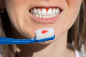 dentist for bleeding gums