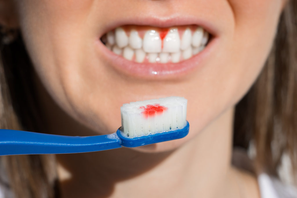 dentist for bleeding gums