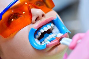 fluoride treatment for adults