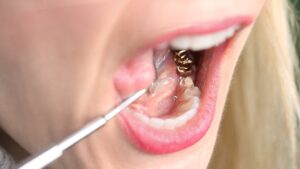 gold tooth