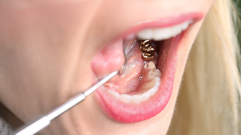 gold tooth
