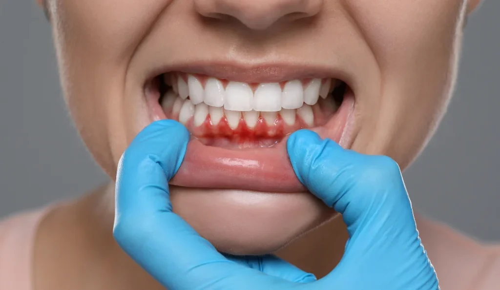 gum recession treatment