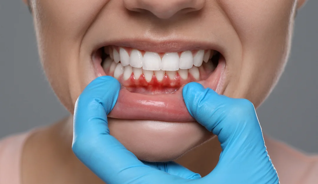 gum recession treatment