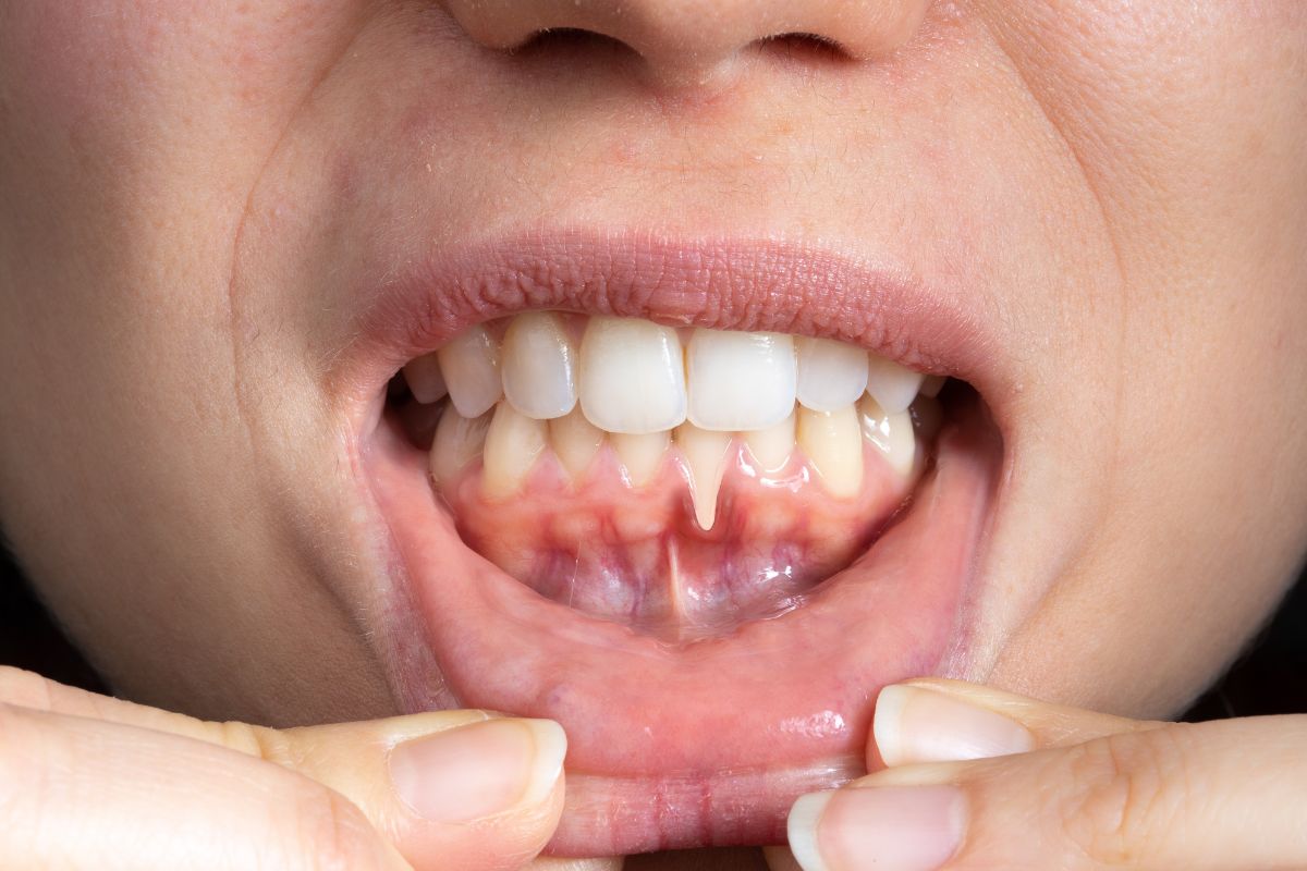 sore gums