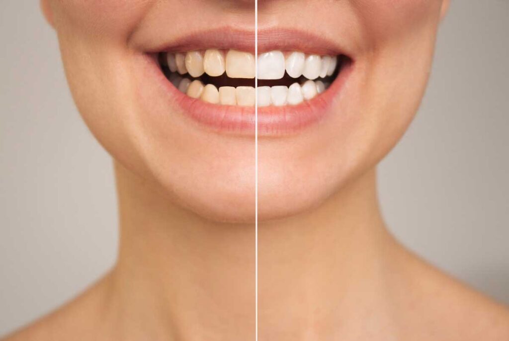 teeth whitening before and after​