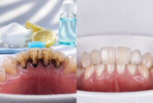 Black Stuff on Teeth