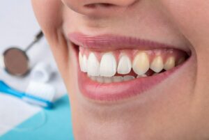Chipped tooth
