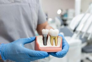 Dental Implants in New York