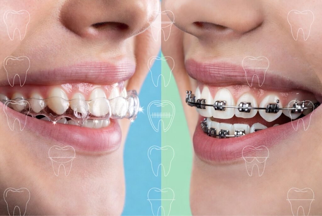 Invisalign vs traditional braces