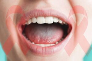 Oral cancer awareness and early signs