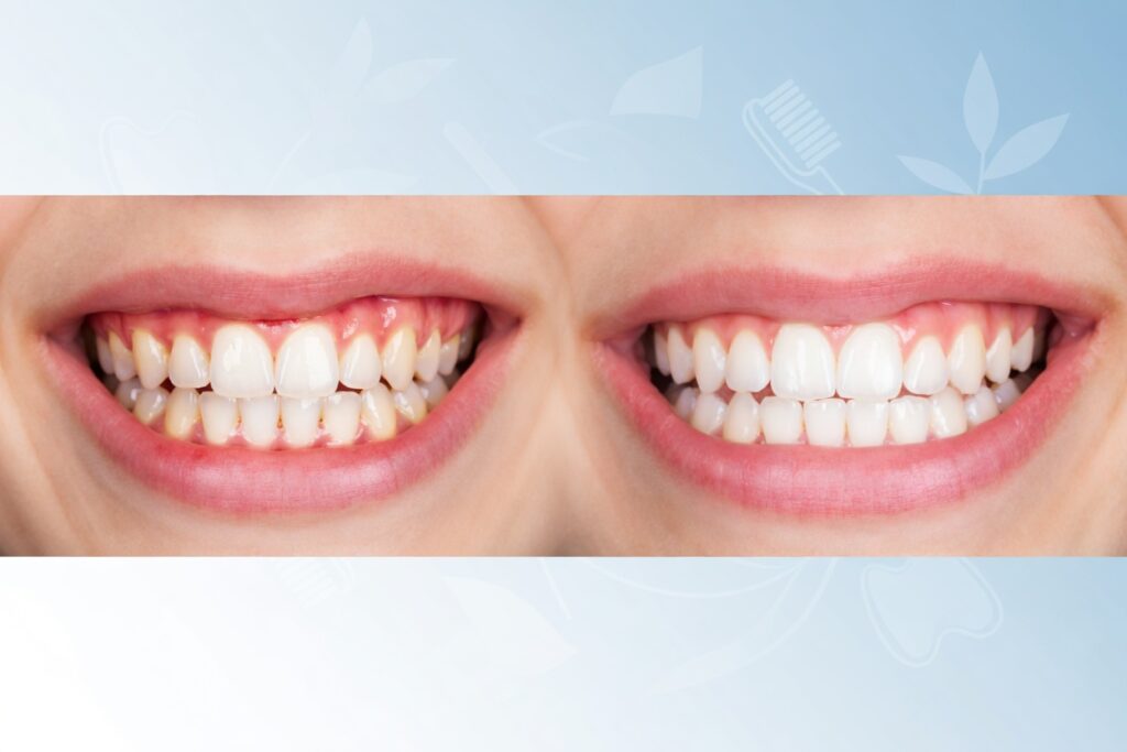 infected gums cure​