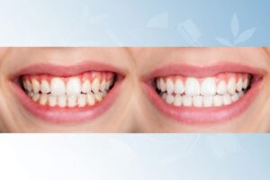 infected gums cure​