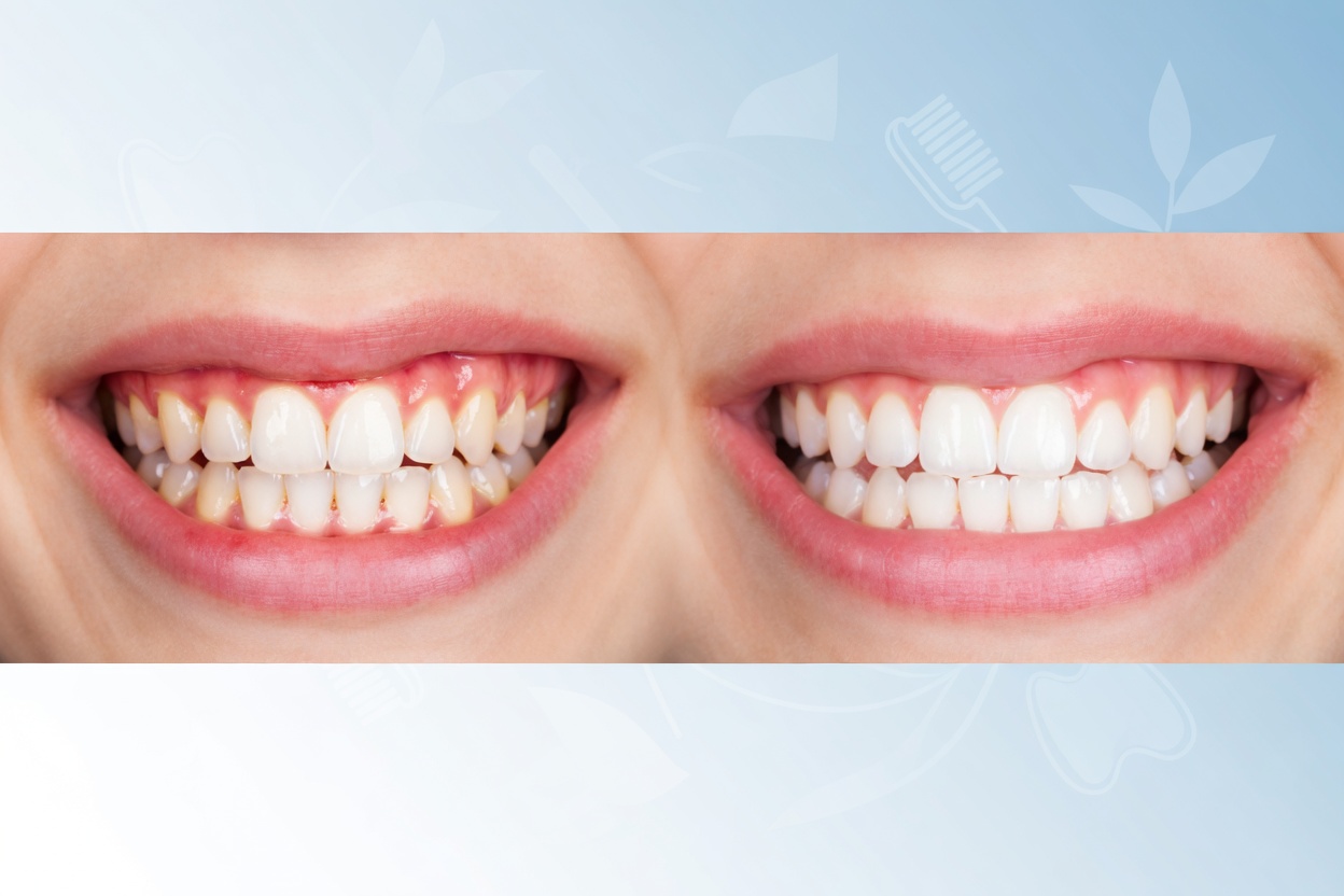 infected gums cure​