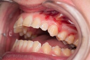red blotches on gums