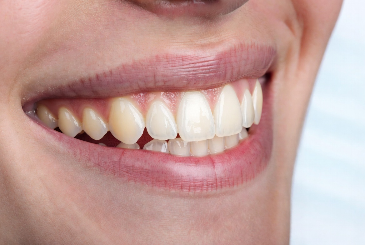 teeth whitening aftercare tips