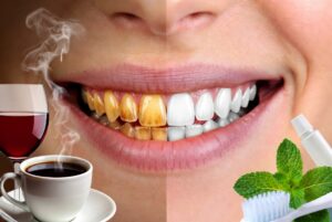 yellow teeth causes and solutions