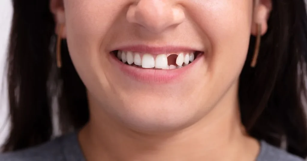 best solution for missing teeth