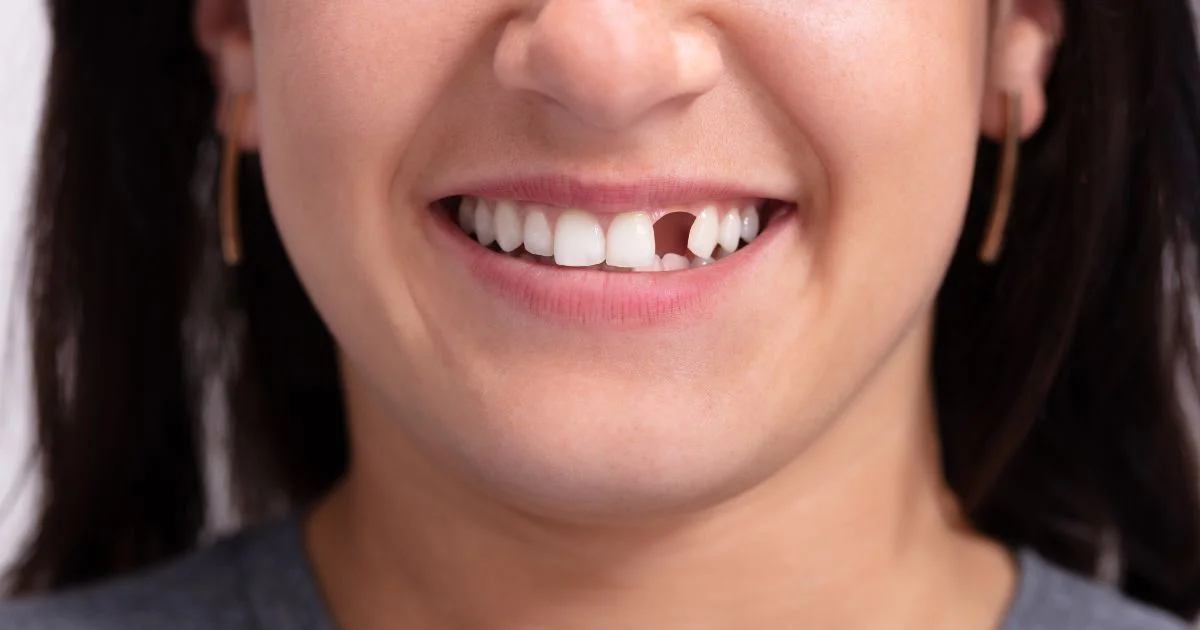 best solution for missing teeth