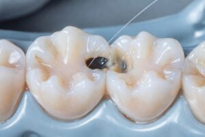cavity between teeth