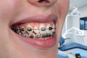 lingual braces treatment