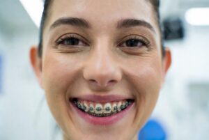 self-ligating braces