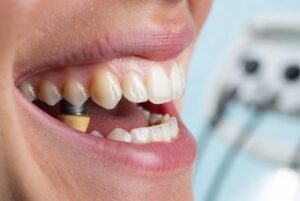 zirconia dental implants Denver