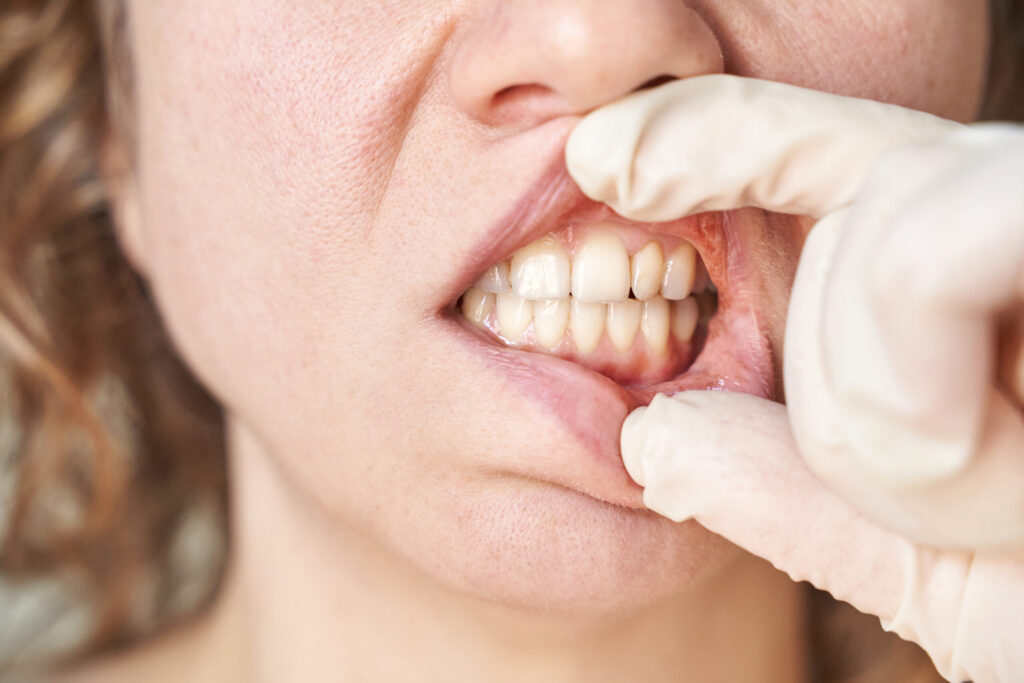 receding gums treatment options